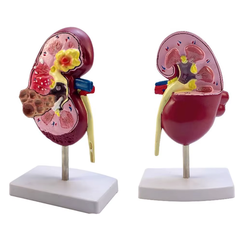 Modèle anatomique de rein normal et pathologique, système urinaire de rein malade, orgue, cadeau méd