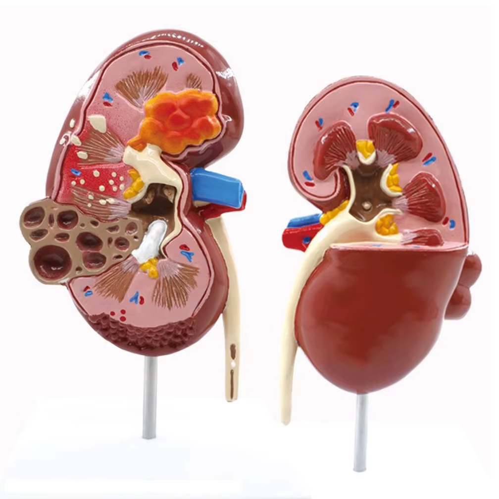 Modèle anatomique de rein normal et pathologique, système urinaire de rein malade, orgue, cadeau médical, équipement éducatif, enseignement
