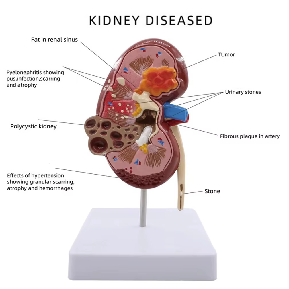 Modèle anatomique de rein normal et pathologique, système urinaire de rein malade, orgue, cadeau médical, équipement éducatif, enseignement