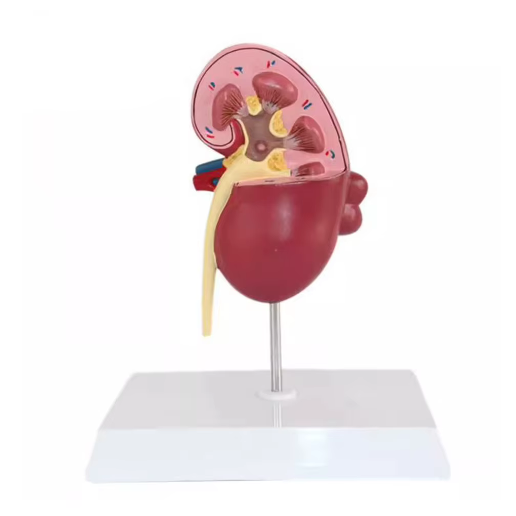 Modèle anatomique de rein normal et pathologique, système urinaire de rein malade, orgue, cadeau médical, équipement éducatif, enseignement